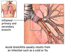 Acute Bronchitis